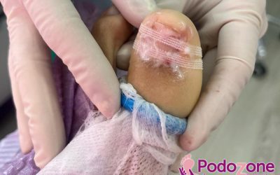 Cirugía de onicocriptosis con la técnica de fenol-alcohol