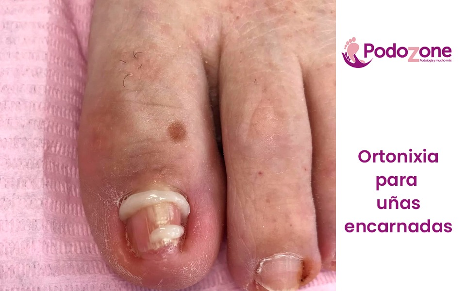 Ortonixia para uñas encarnadas en Málaga