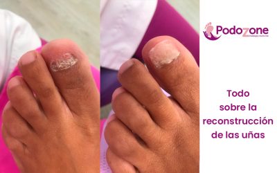 Todo sobre la reconstrucción de las uñas