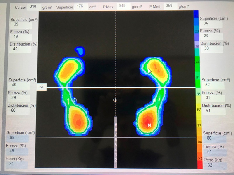 Baropodometría en Málaga