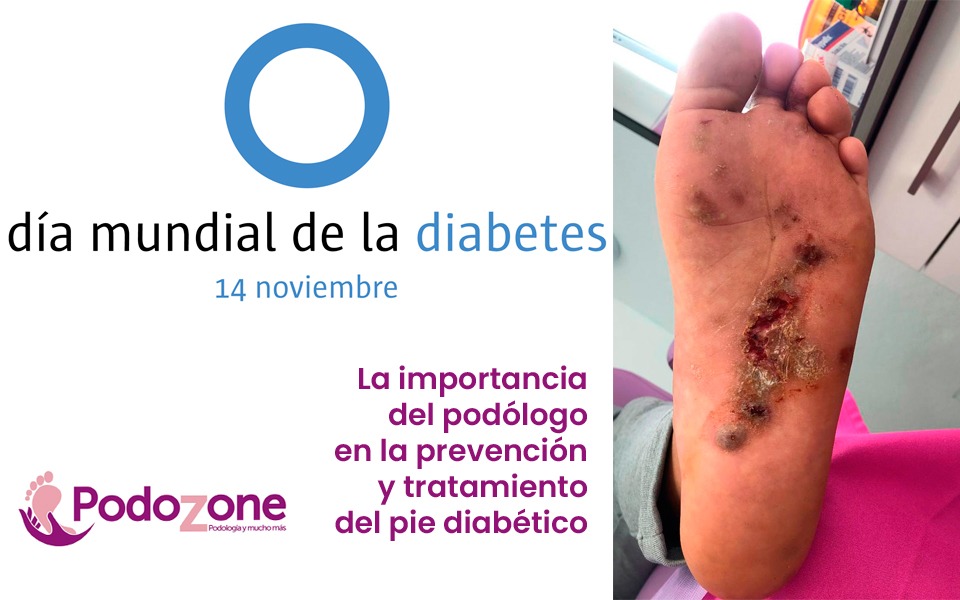 la importancia del podólogo en la prevención y tratamiento del pie diabético